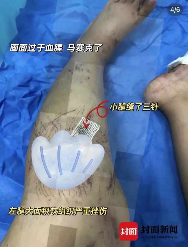 女子巴厘岛打卡恶魔的眼泪险丧命：被几米高的海浪拍倒在礁石上造成多处受伤