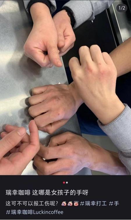瑞幸被曝洗手流程致员工烂手_瑞幸被曝洗手流程致员工烂手_瑞幸被曝洗手流程致员工烂手