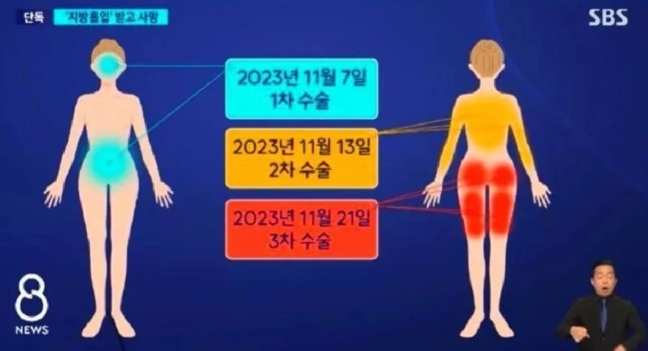 韩国抽脂手术价格_女子抽脂死在手术台_中国女子在韩接受抽脂手术后死亡