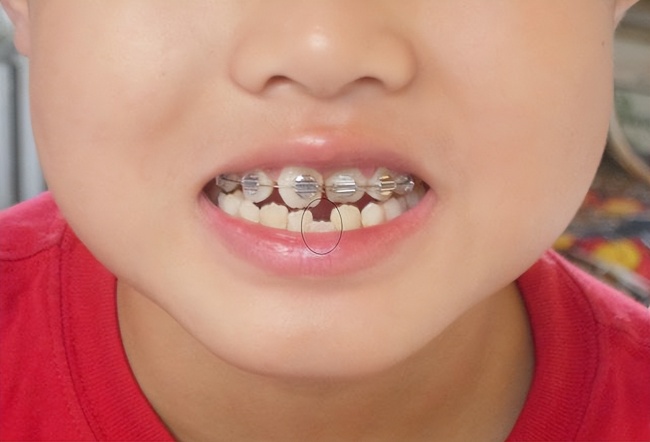两岁半幼童每天戴12小时牙套 低龄矫治引争议