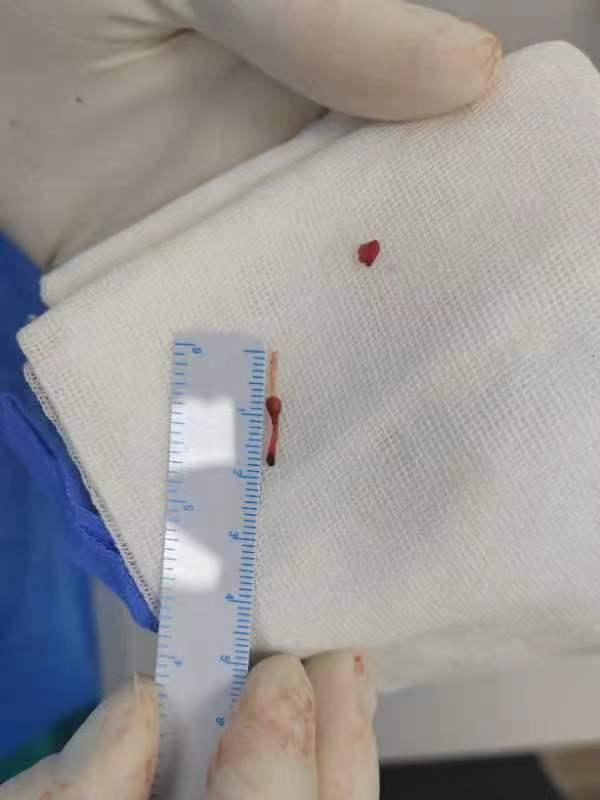 留置针导管在婴儿血管里漂移5年_留置针血管变硬凸起_留置针拔针