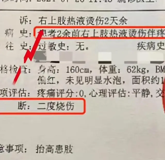 吃达美乐被烫成二度烧伤_烫烧伤用什么药_烫烧伤怎么处理