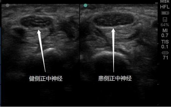 职业病目录新增“鼠标手”