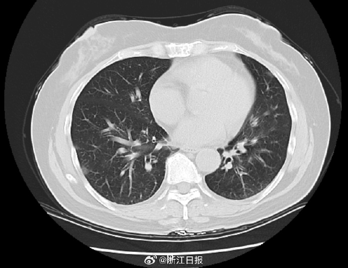 一家6口出游5人感染甲流 如何分辨甲流和普通感冒