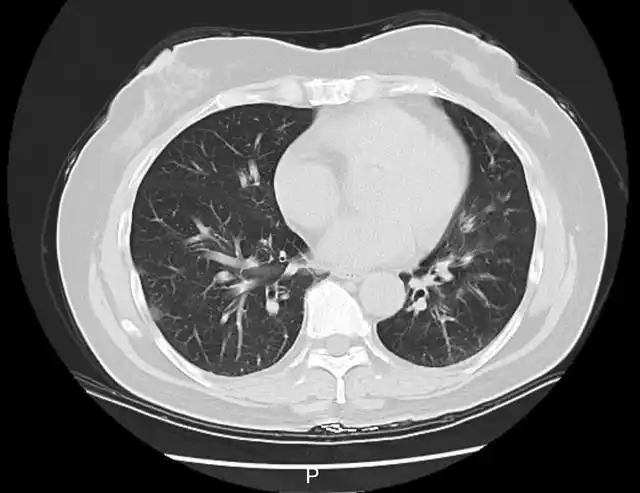 感染甲流的主要症状有哪些_感染甲流怎么治疗_一家6口出游5人感染甲流