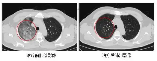 江苏什么病情传染了5000人_江苏发现新型传染病_江苏确诊一例罕见传染病