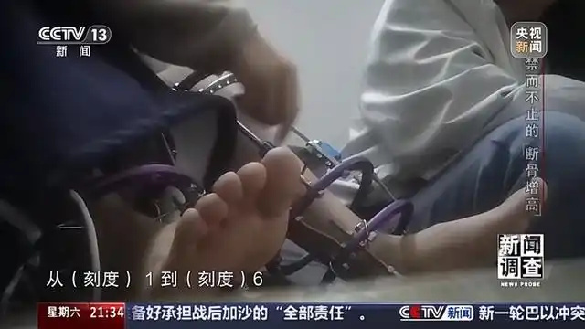 央视曝断骨增高灰色产业链_央视曝断骨增高灰色产业链_央视曝断骨增高灰色产业链