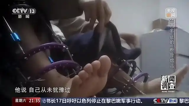 央视曝断骨增高灰色产业链_央视曝断骨增高灰色产业链_央视曝断骨增高灰色产业链