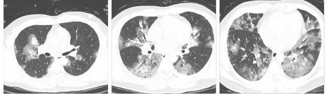 男子感染流感短短几天出现白肺 重症病例敲响警钟