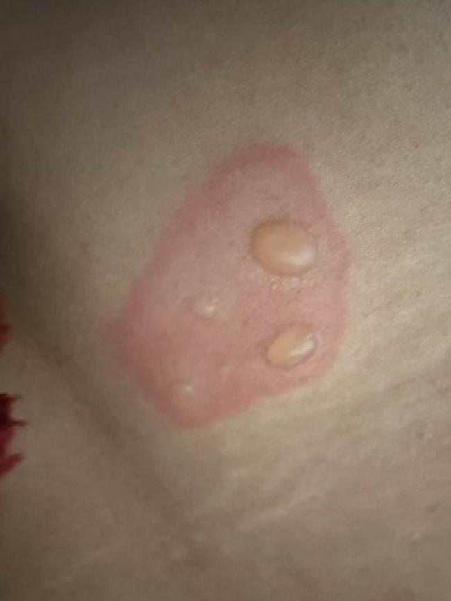 女生长期把电脑放腿上办公长出蟒蛇纹