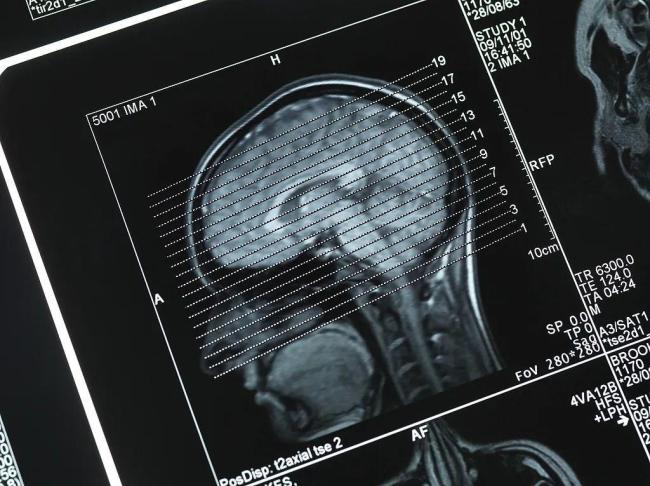 女子鼻子变大医生一眼看出不对劲 意外发现脑垂体瘤