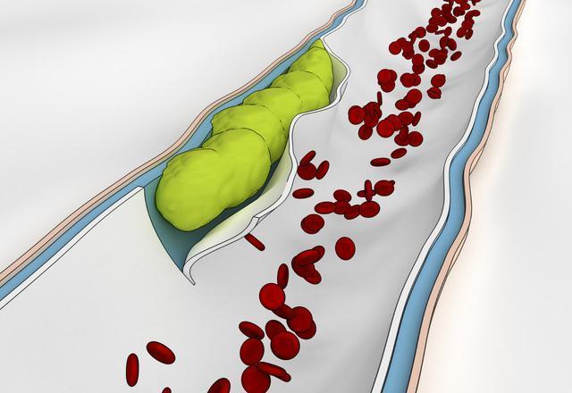女子崴脚静养一周后竟引起肺栓塞 小小意外酿成大祸