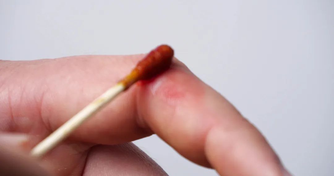 碘伏没有用什么代替_碘伏是万能的吗_碘伏没有那么“万能”