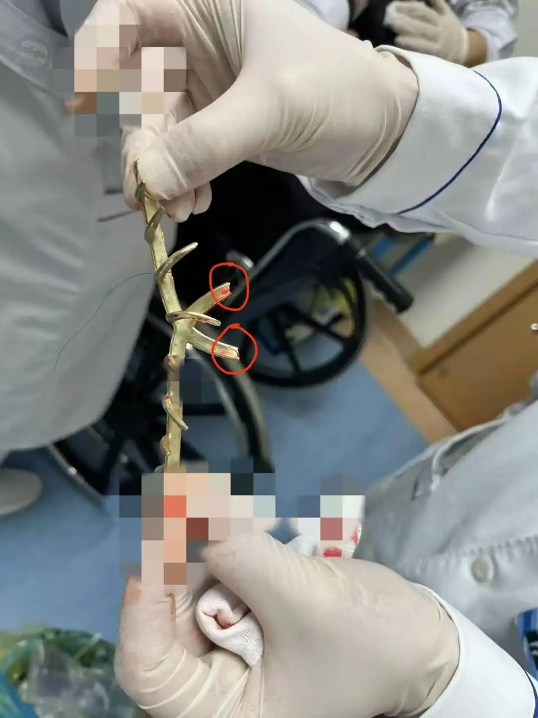 老人撞到后脑勺什么症状要注意_六旬老人被车撞倒 鲨鱼夹扎进后脑勺_老人撞倒后脑勺怎么办