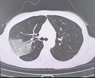 女子硬扛流感高烧3天 医生回应