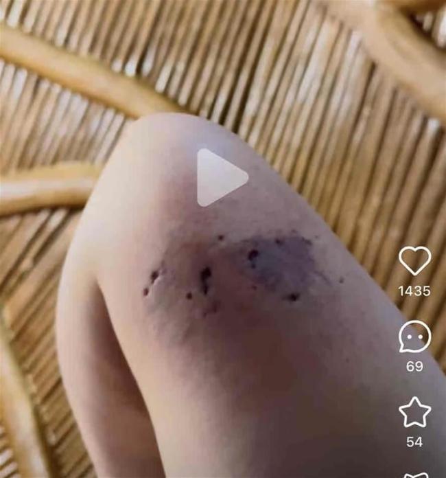 男子住动物园酒店 被小熊猫进屋咬伤 酒店已派专员处理