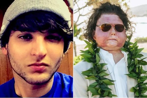 全球首例同时换脸换手男子结婚