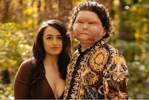 全球首例同时换脸换手男子结婚 爱情超越一切