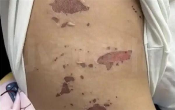 吃火锅烫到口腔溃疡_吃火锅嘴皮烫破_3岁男童吃火锅烫嘴后竟全身溃烂