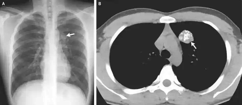 胳膊钙化怎么治疗_杨幂谈胳膊钙化_胳膊钙化灶