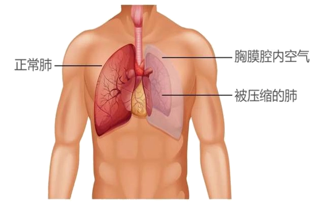 气胸是什么原因引起的_气胸是什么_气胸是哪个部位疼