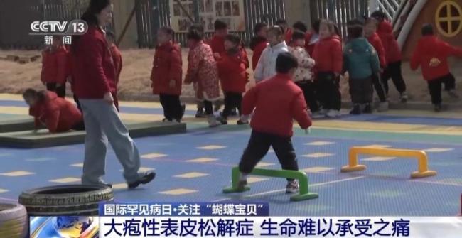 女孩确诊“蝴蝶宝贝”皮肤一碰就碎