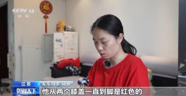 女孩确诊“蝴蝶宝贝”皮肤一碰就碎 罕见病痛引关注