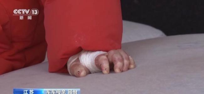 女孩确诊“蝴蝶宝贝”皮肤一碰就碎 罕见病痛引关注