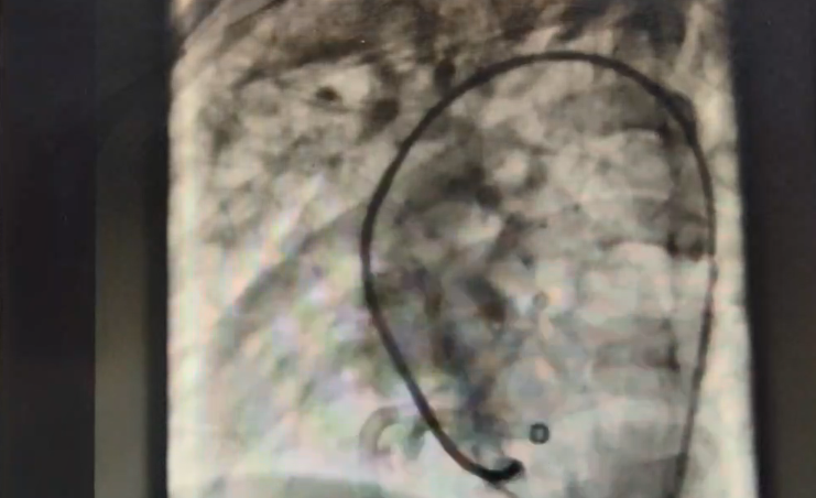 心脏破洞会有什么症状_4岁男孩心脏上破了5个“洞”_心脏破洞会越来越大吗