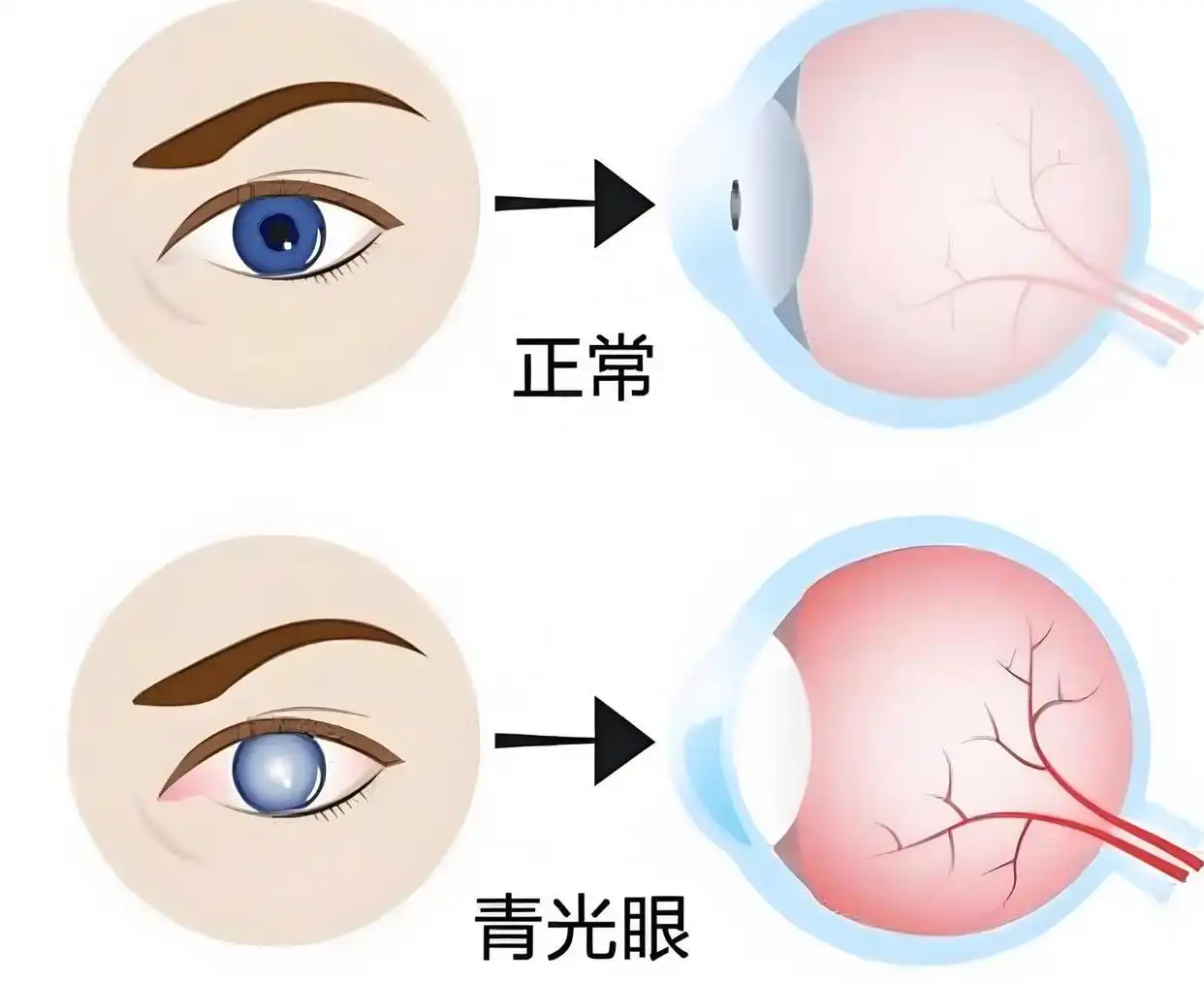 世界青光眼日_青光眼世界最新突破_青光眼世界都治不了吗
