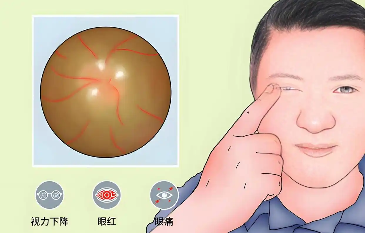 青光眼世界最新突破_世界青光眼日_青光眼世界都治不了吗