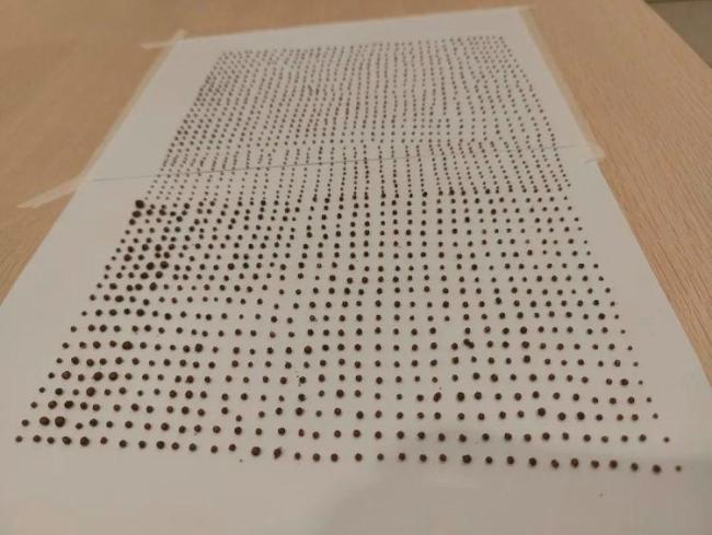 64岁大爷体内取出1791颗结石