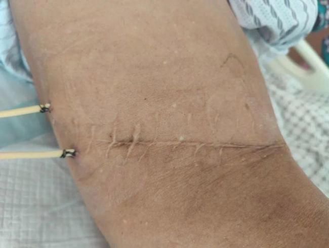 64岁大爷体内取出1791颗结石 手术团队惊呆了